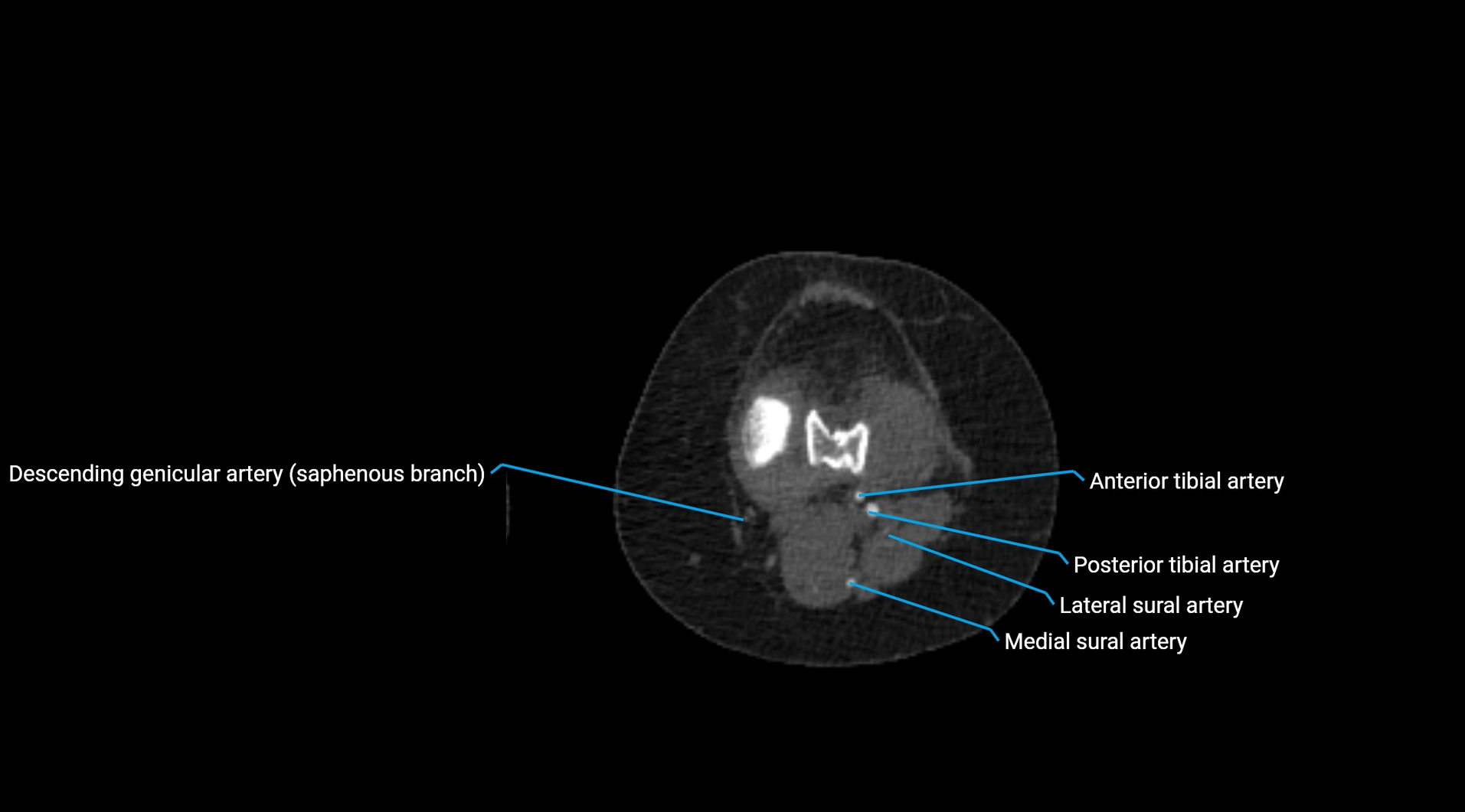 CTA lower limb cross sectional anatomy labelled image _177.webp